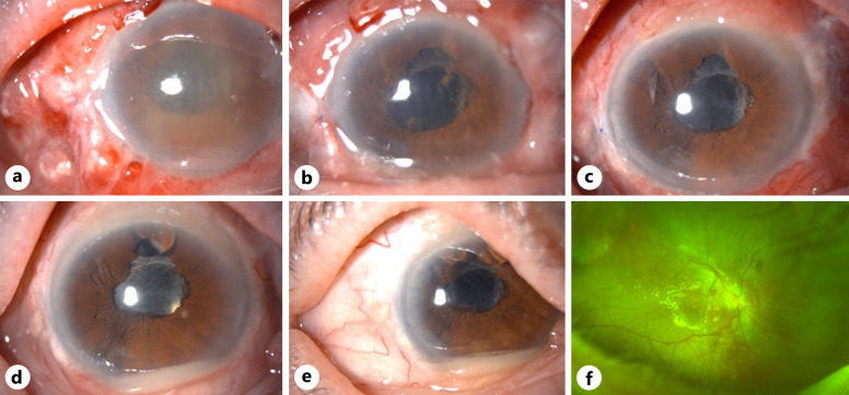 A Severe Case of Infectious Necrotizing Anterior Scleritis Caused by <i>Pseudomonas aeruginosa</i> after Vitreoretinal Surgery.