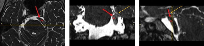 Microvascular Decompression: An Effective Approach for Trigeminal Neuralgia Caused by a Dolichoectatic Basilar Artery after Multiple Treatment Failures.