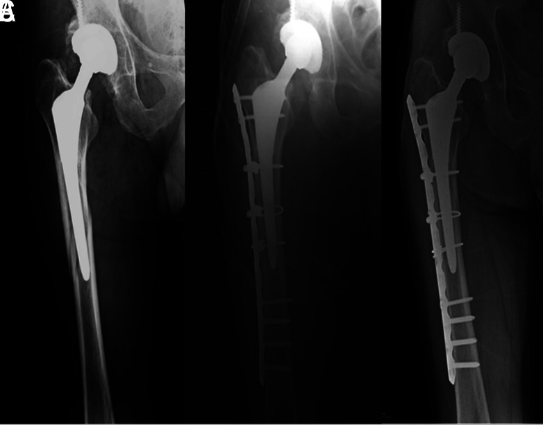Surgical outcomes of cable plate fixation in treatment of Vancouver type B1 and type C periprosthetic femoral fractures: a retrospective case series.