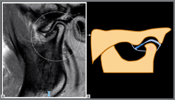 Unveiling MRI-based structural phenotypes in temporomandibular joint osteoarthritis: implications for clinical practice and research.