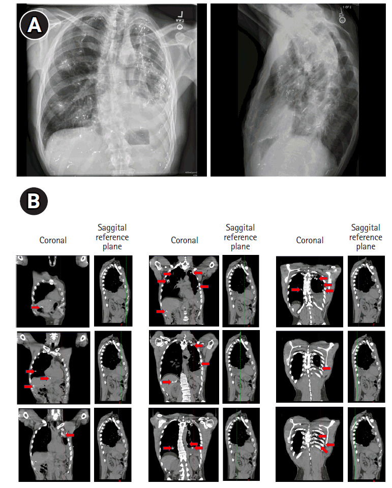 Long-term treatment of metastatic adenoid cystic carcinoma with sequential brachytherapy and stereotactic body radiotherapy.