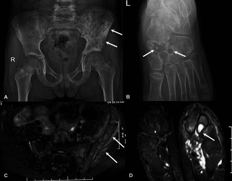 Chronic Noninfectious Osteomyelitis: A Review of Imaging Findings.