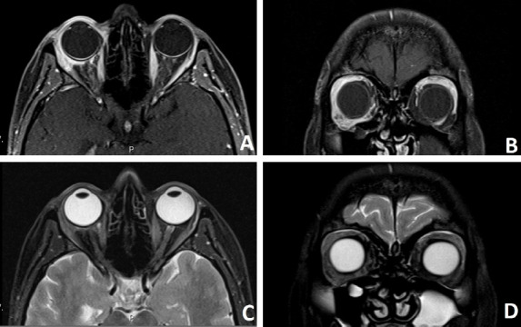 Orbital Metastasis from Breast Cancer: Three Cases and Brief Review of the Literature.
