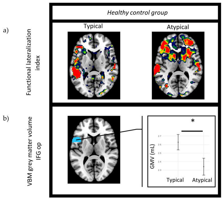 Assessing Language Lateralization through Gray Matter Volume: Implications for Preoperative Planning in Brain Tumor Surgery.