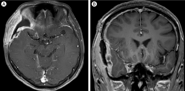 The efficacy of surgical site suction drain insertion in pterional craniotomy for intracranial cerebral aneurysm.