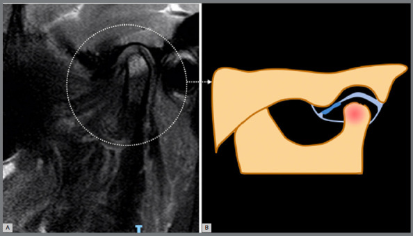 Unveiling MRI-based structural phenotypes in temporomandibular joint osteoarthritis: implications for clinical practice and research.