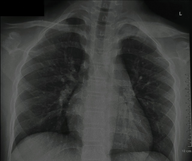 Chronic Noninfectious Osteomyelitis: A Review of Imaging Findings.