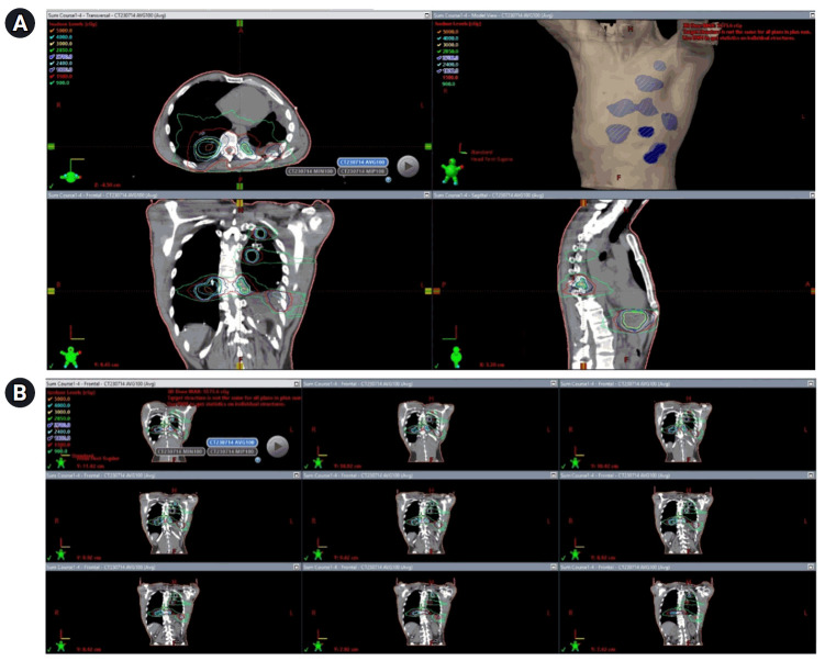 Long-term treatment of metastatic adenoid cystic carcinoma with sequential brachytherapy and stereotactic body radiotherapy.