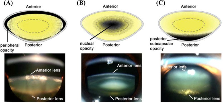 UV light and the ocular lens: a review of exposure models and resulting biomolecular changes.