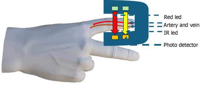 Pulse oximetry in pediatric care: Balancing advantages and limitations.
