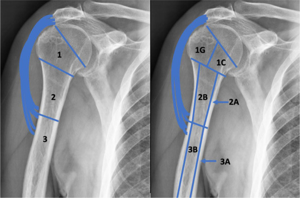 Revision shoulder arthroplasty and proximal humeral bone loss: a comprehensive review and proposal of a new algorithm of management.