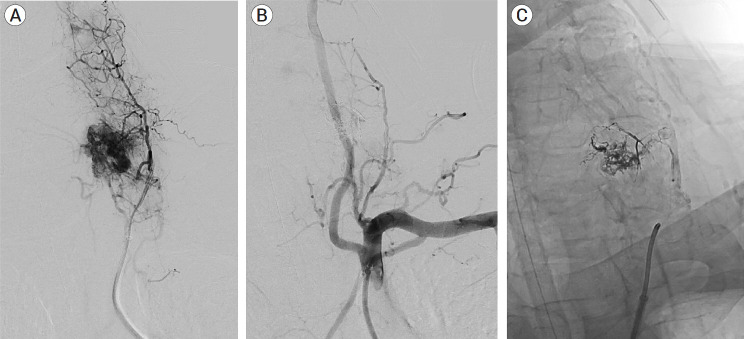 Preoperative embolization and en bloc resection of a metastatic pheochromocytoma of the cervical spine.