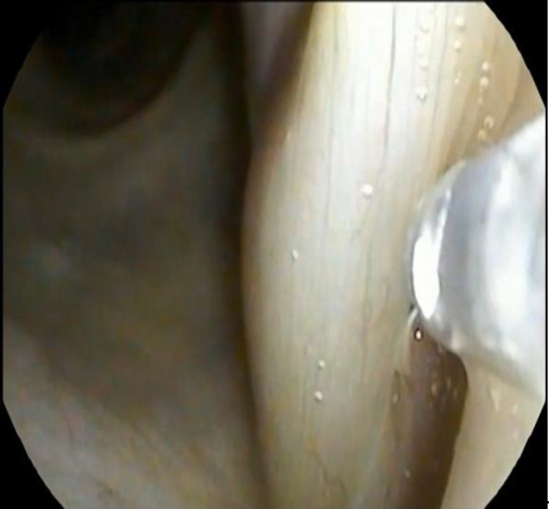 Transnasal Endoscopic Injection of Botulinum Toxin in Patients with Adductor Spasmodic Dysphonia.