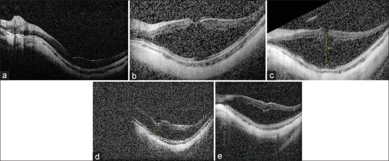 Childhood Myopic Foveoschisis in LRPAP1-associated Myopia.