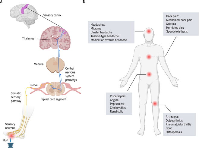 Sensors and Devices Guided by Artificial Intelligence for Personalized Pain Medicine.