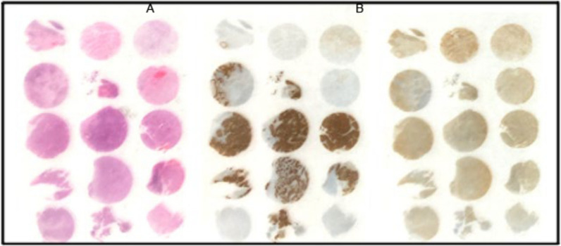 cIAP-2 protein is upregulated by human papillomavirus in oropharyngeal cancers: role in radioresistance in vitro.