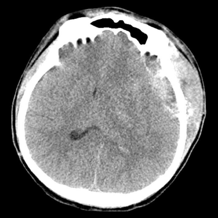 The efficacy of surgical site suction drain insertion in pterional craniotomy for intracranial cerebral aneurysm.