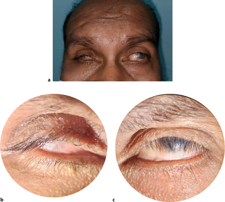 Management of Painful Blind Eye with Bilateral Symblepharon: A Case Report.
