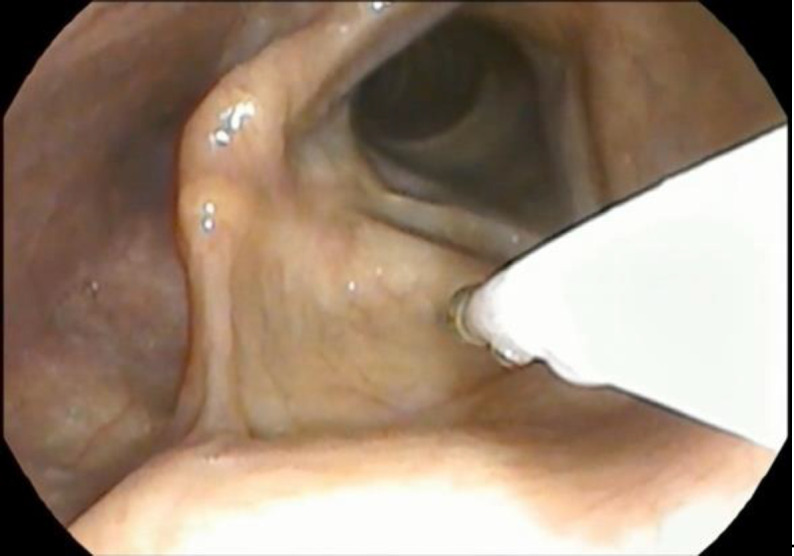 Transnasal Endoscopic Injection of Botulinum Toxin in Patients with Adductor Spasmodic Dysphonia.