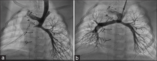 Early and midterm results of Cook Formula stent in children with right heart disease: A single-center experience.