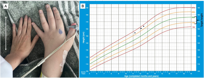 Pituitary gigantism due to a novel <i>AIP</i> germline splice-site variant.
