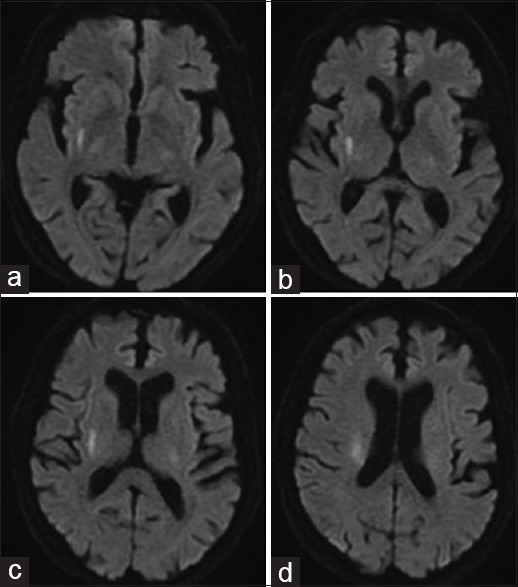 Intravenous thrombolysis plus tirofiban versus tirofiban alone in Caucasian patients with acute anterior choroidal or paramedian pontine infarction.