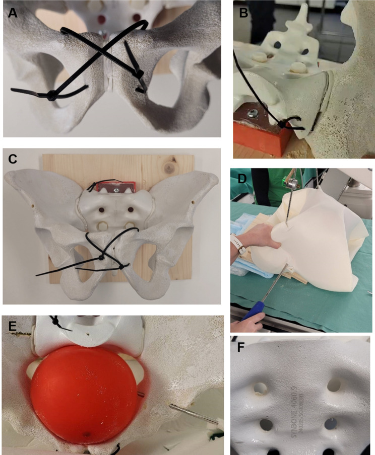 Improving surgical technical skills for emergency fixation of unstable pelvic ring fractures: an experimental study using a pelvic ring fracture simulator.