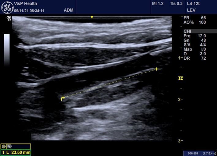 Endovenous laser ablation for saphenous veins and tributaries - the LEST technique.