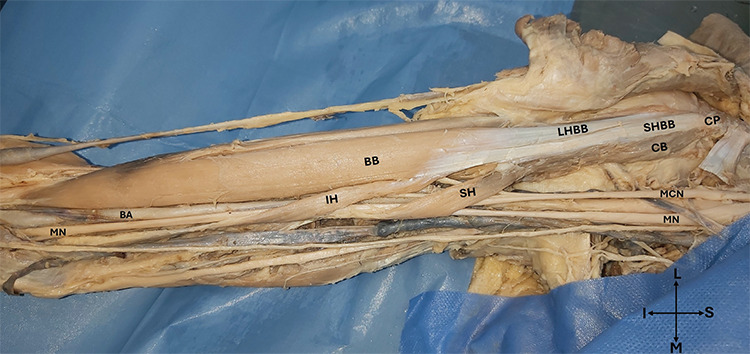Revisiting the Muscles and Nerves of Anterior Compartment of the Arm: A Case Report.
