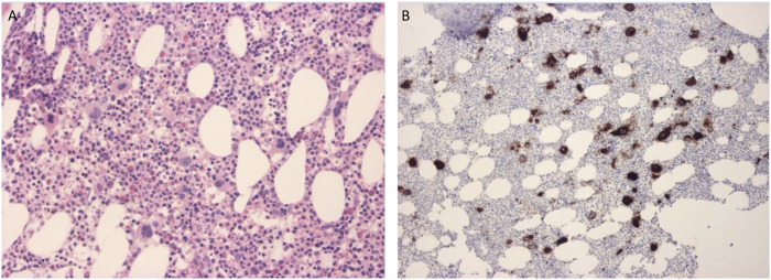Case report: Comprehensive clinical, pathological and genetic investigations to decipher the background of cyclic thrombocytopenia.
