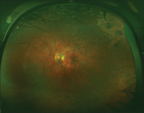 Childhood Myopic Foveoschisis in LRPAP1-associated Myopia.