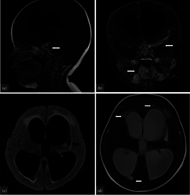 Tuberculosis Meningitis in a 9-Month-Old Girl during the COVID-19 Pandemic.