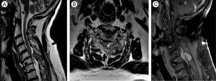 Preoperative embolization and en bloc resection of a metastatic pheochromocytoma of the cervical spine.
