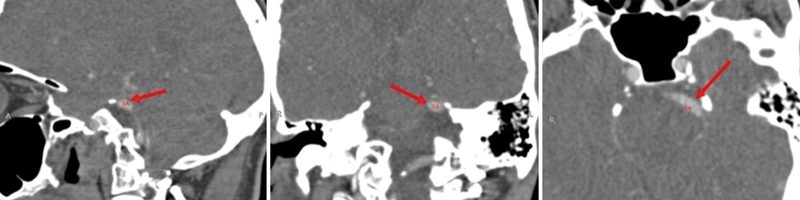 Microvascular Decompression: An Effective Approach for Trigeminal Neuralgia Caused by a Dolichoectatic Basilar Artery after Multiple Treatment Failures.
