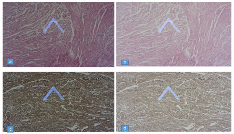 Rapidly Growing Leiomyoma Mimicking Schwannoma of the Saphenous Nerve in the Lower Extremity: An Unusual Case Report.