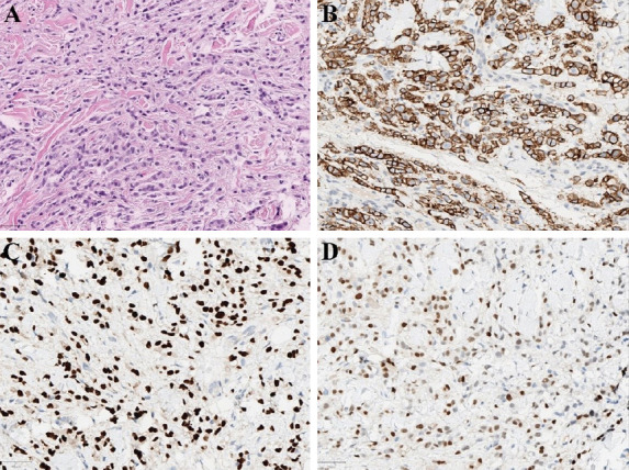 Orbital Metastasis from Breast Cancer: Three Cases and Brief Review of the Literature.