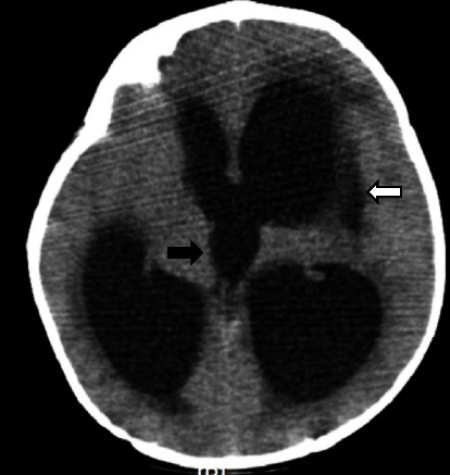 Tuberculosis Meningitis in a 9-Month-Old Girl during the COVID-19 Pandemic.