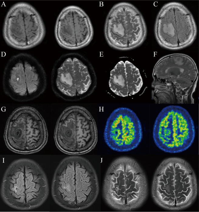 Synergistic Integration of Traditional Chinese Medicine and Western Medical Intervention in the Treatment of Brain Abscess: A Case Report.