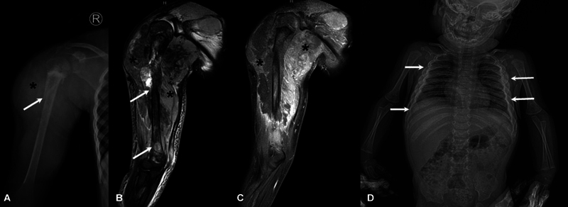 Chronic Noninfectious Osteomyelitis: A Review of Imaging Findings.