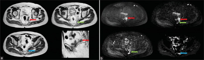 Sacral Radiculoplexopathy Caused by Direct Perineural Spread of Carcinoma Prostate Diagnosed in Ga-68 PSMA PET/CT.
