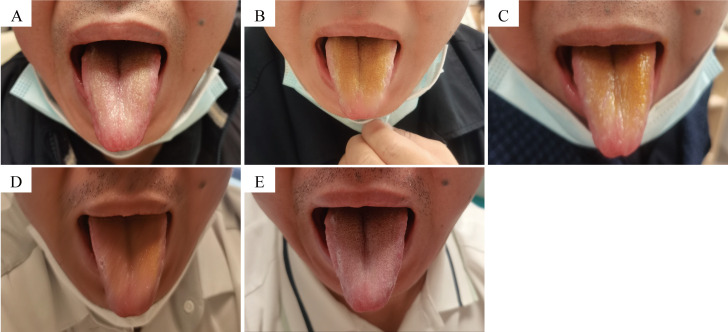 Synergistic Integration of Traditional Chinese Medicine and Western Medical Intervention in the Treatment of Brain Abscess: A Case Report.
