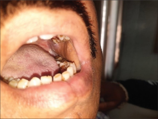 Infrahyoid myocutaneous flap for reconstruction in head and neck cancer patients.