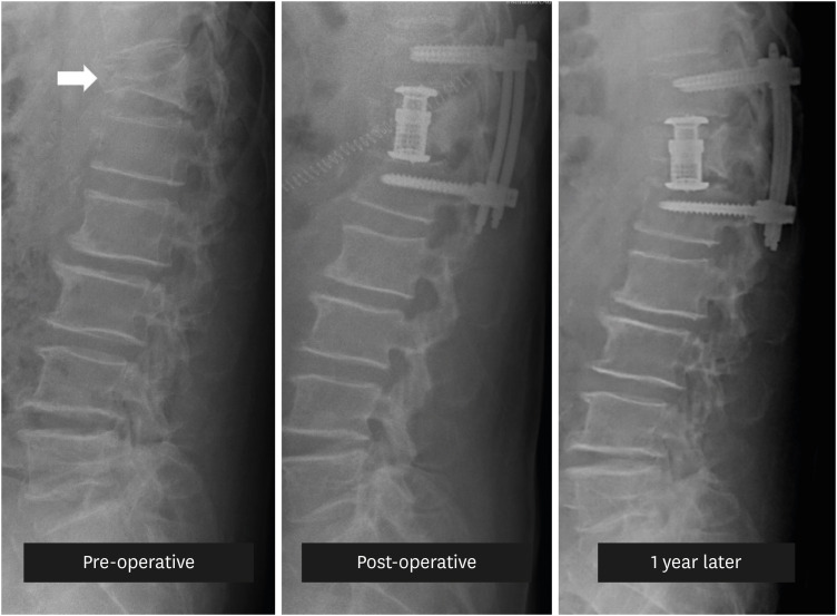 Pain Intervention for Osteoporotic Compression Fracture, From Physical Therapy to Surgery: A Literature Review.