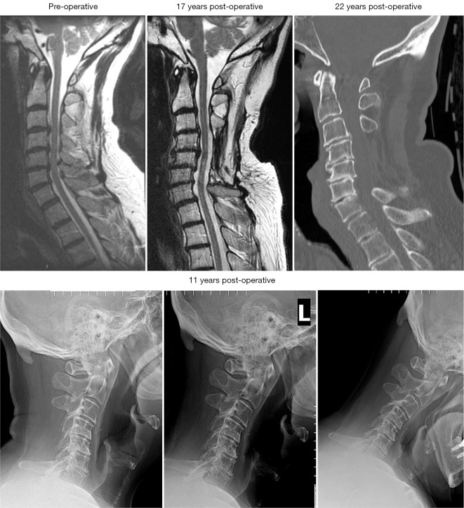 Treatment strategies for cervical spondylotic myelopathy-is laminectomy alone a safe and effective option?