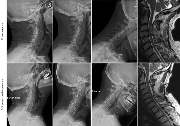 Treatment strategies for cervical spondylotic myelopathy-is laminectomy alone a safe and effective option?