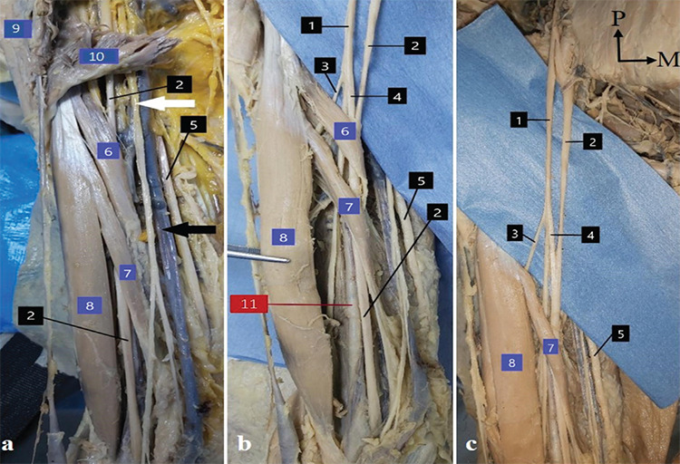 Revisiting the Muscles and Nerves of Anterior Compartment of the Arm: A Case Report.