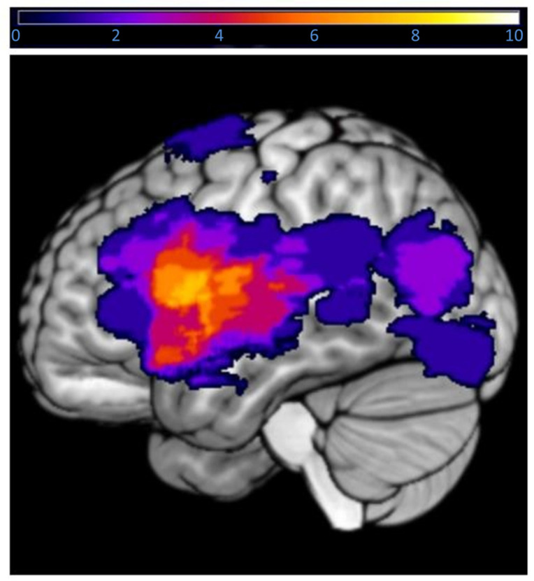Assessing Language Lateralization through Gray Matter Volume: Implications for Preoperative Planning in Brain Tumor Surgery.