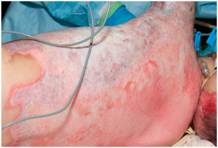 Diagnosis and Treatment of Infections in the Burn Patient.