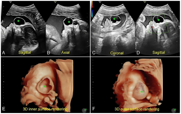 Unusual Case of Fetal Meningocele Mimicking Dacryocystocele.