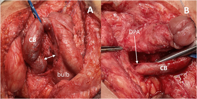 Modified penile reconstruction in classic bladder exstrophy: Can complete corporal covering of the urethral closure be achieved using incomplete disassembly technique?